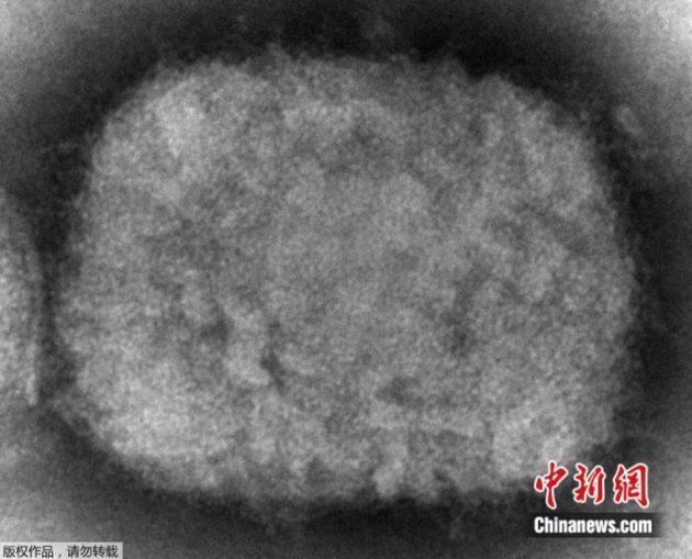 资料图：美国疾病控制和预防中心(CDC)提供的2003年电子显微镜图像显示了一种猴痘病毒粒子。